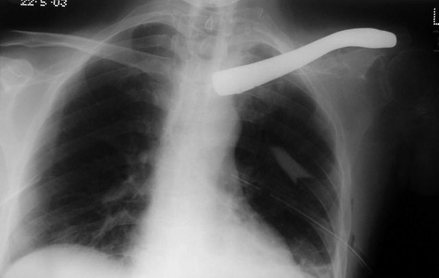 Claviculoplasty x-ray Post-op.jpg (689775 bytes)